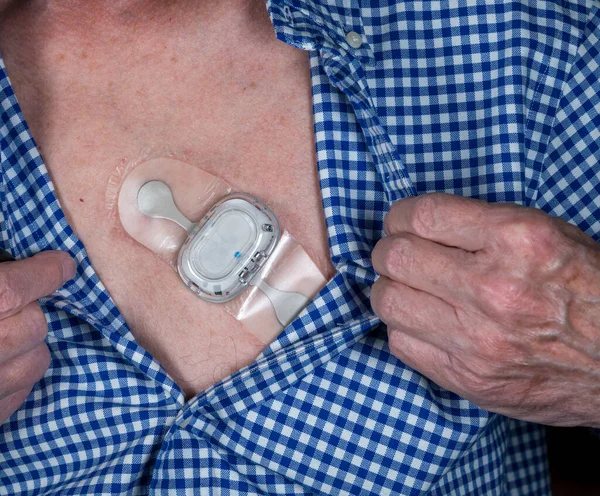 男性胸部小粘连性心电图长期心率监测 — 图库照片