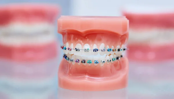Apparecchi Dentali Allineare Raddrizzare Denti Modello Apparecchio Mascelle Superiore Inferiore — Foto Stock