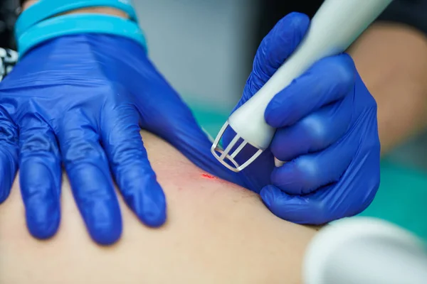 Dermatologia Estética Laser Revisão Tratamento Cicatriz Com Laser Dióxido Carbono — Fotografia de Stock