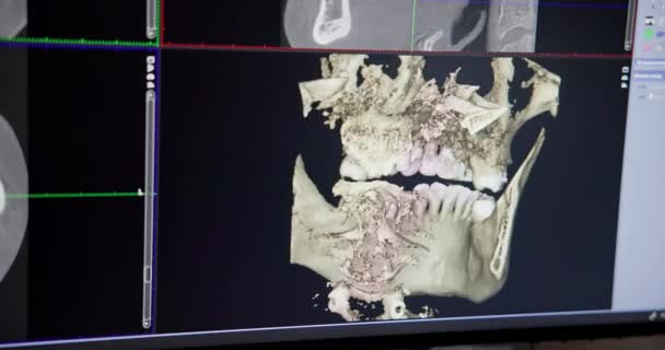 Concepto Odontología Moderna Médico Dentista Mira Monitor Con Modelo Rayos — Vídeos de Stock