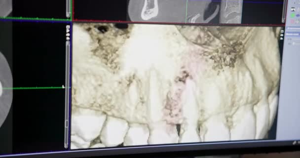 Сучасна Концепція Стоматології Лікар Стоматолог Дивиться Монітор Моделлю Рентгенівських Променів — стокове відео