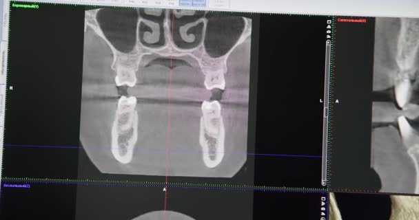 Concepto Odontología Moderna Médico Dentista Mira Monitor Con Modelo Rayos — Vídeo de stock