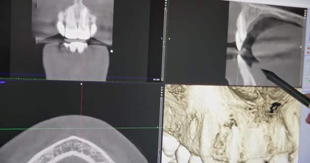 Сучасна Концепція Стоматології Лікар Стоматолог Дивиться Монітор Моделлю Рентгенівських Променів — стокове відео