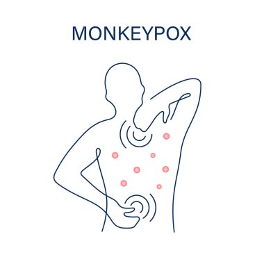 Maymun çiçeği, mpox virüsü kızarıklık belirtileri 