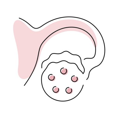PCOS, Polycystic Ovary Sendromu Tıbbi İllüstrasyon