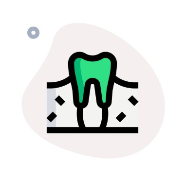 Bir diş, çenelerde kireçlenmiş bir yapı bulundu