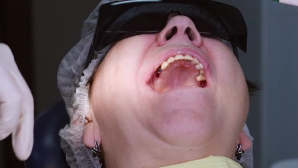 Chirurg Oralny Wkręcający Implant Gumę Kość Szczęki Starszej Pani Dentysta — Wideo stockowe