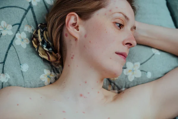 Жінка Віспою Лежить Ліжку Портрет — стокове фото