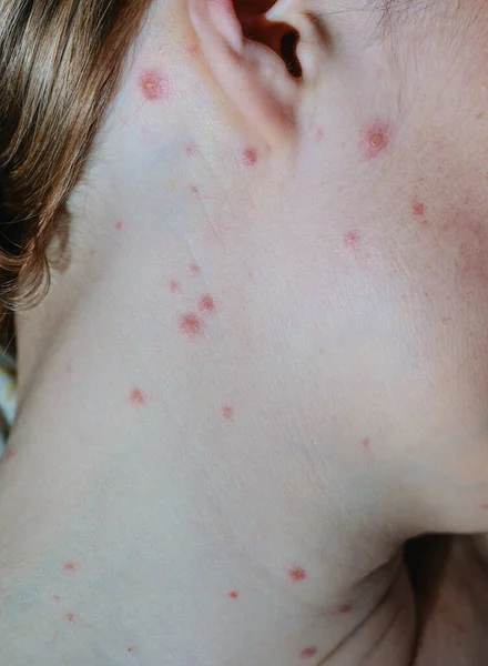 Close Uma Mulher Com Varíola Frango — Fotografia de Stock