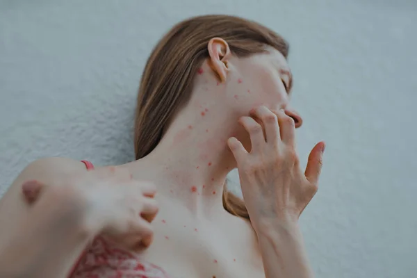 A woman with chicken pox scratches her skin