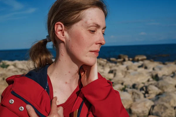 Retrato Uma Mulher Triste Com Varíola Frango Praia — Fotografia de Stock