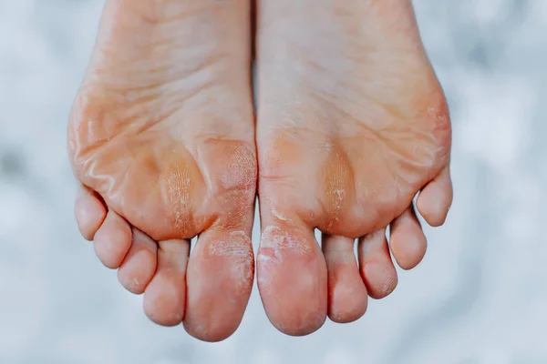 Unkempt Woman Feet Woman Feet Pedicure — Stock Photo, Image