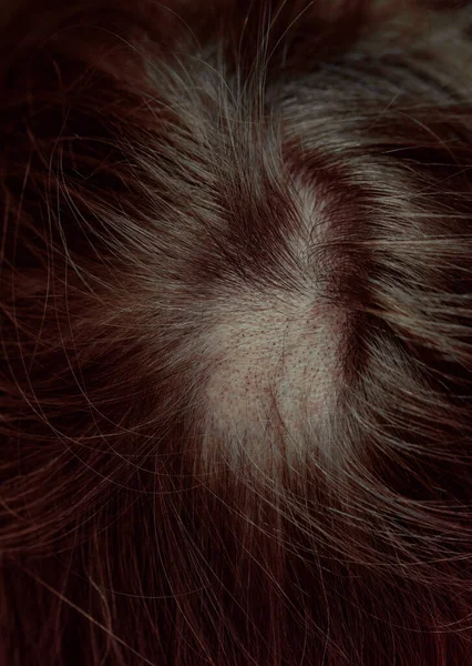 Vrouwelijk Hoofd Met Allopecia Close — Stockfoto