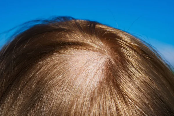 Kvinnligt Huvud Med Allopeci Närbild — Stockfoto