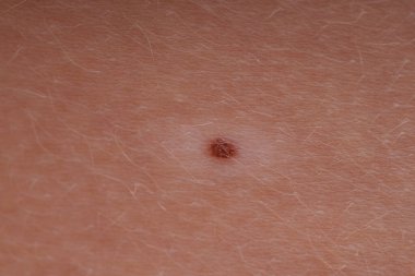 Bir çocuğun vücudundaki beni yakından çek.