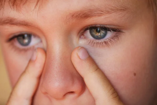 Allergic Boy Scratching His Eyes Close View — Stock Photo, Image