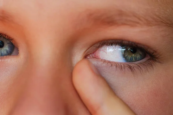 Alergiczny Chłopiec Drapiący Się Oczach Widok Bliska — Zdjęcie stockowe