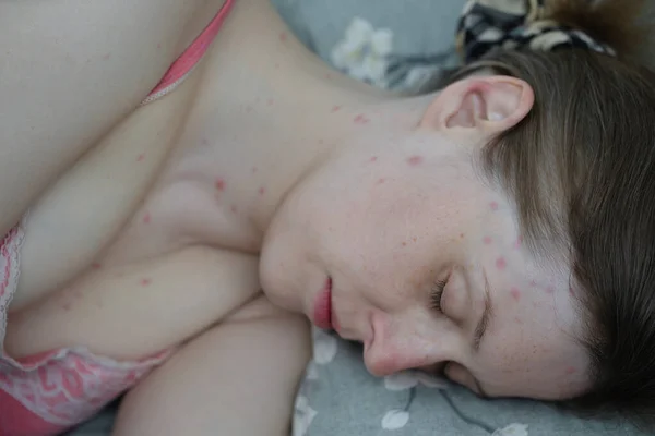 Suçiçeği Hastası Genç Bir Kadın Yatakta Uyuyor — Stok fotoğraf