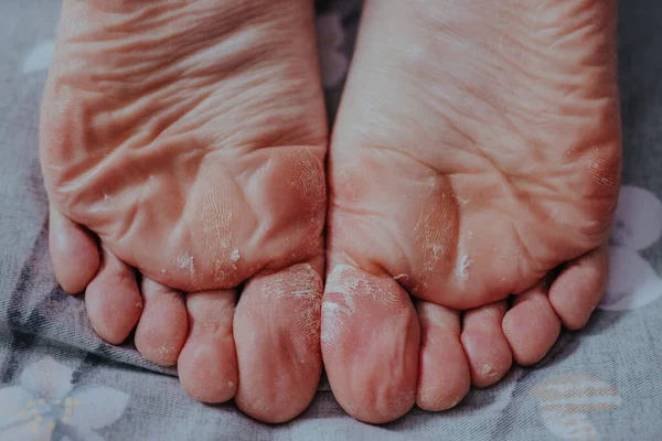 Peeling Skóry Nogi Kobiety Widok Bliska — Zdjęcie stockowe
