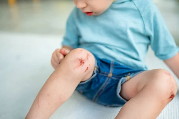 Toddler Boy Sore Scraped Knees Parent Helping Her Child Perform — Stock Photo, Image