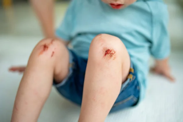 蹒跚学步的男孩 膝盖酸痛 父母帮助她的孩子在事故发生后进行膝伤急救 — 图库照片