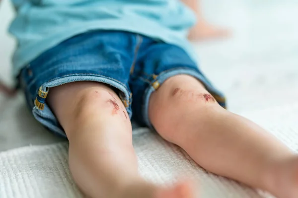 痛いスクレープ膝を持つ幼児の男の子 彼女の子供が事故にあった後応急処置膝の損傷を実行するのを助ける親 — ストック写真