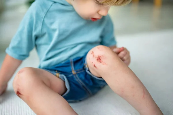 蹒跚学步的男孩 膝盖酸痛 父母帮助她的孩子在事故发生后进行膝伤急救 — 图库照片