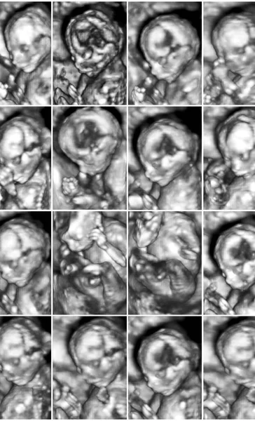 拼贴的 医学图像的三维超声异常处理扫描在女性胎儿 个月到怀孕 — 图库照片