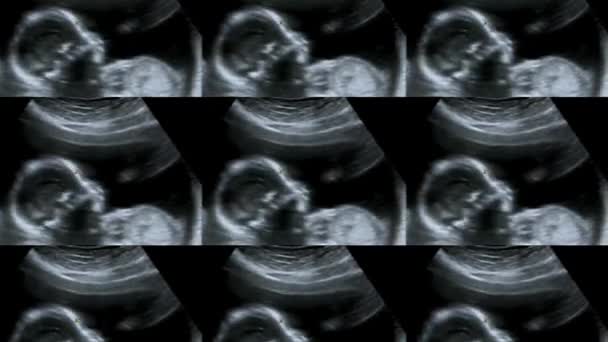 Multi Screen Ultrasound Small Baby Weeks Weeks Pregnant Ultrasound Echography — Stock Video