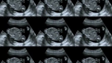 Multi screen ultrasound small baby at 12 weeks. 12 weeks pregnant ultrasound image show baby or fetus development and pregnancy health checking.