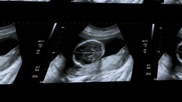 Multi Screen Ultrasound Small Baby Weeks Weeks Pregnant Ultrasound Image — 图库视频影像