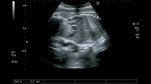 Fetal Ultrasound 7Th Months Fetus Womans Womb — Vídeo de Stock