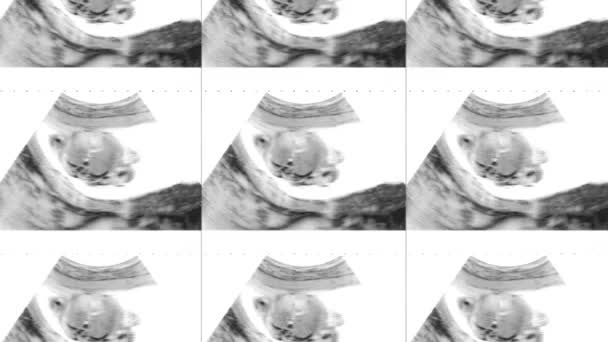 Multi Screen Ultrasound Fetus Mothers Womb — Αρχείο Βίντεο