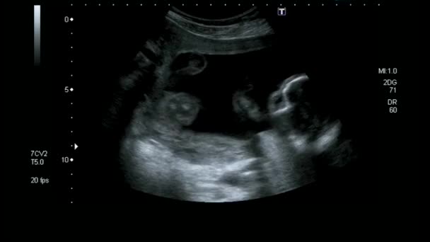 妊娠中の母親子宮超音波 12週時の胎児の超音波 — ストック動画