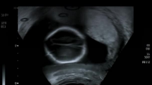 Ecografia Dell Utero Materno Durante Gravidanza Ultrasuoni Feto Settimane — Video Stock