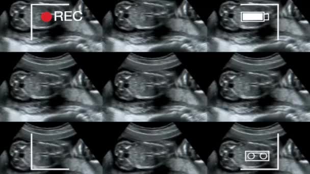 Kolaż Obrazów Medycznych Usg Podczas Skanowania Kobiet Ciąży — Wideo stockowe