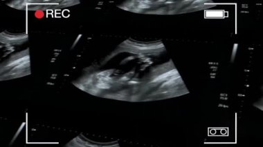 Tıbbi referans ve çalışma için cenin ultrason ekranının bir kolajı..