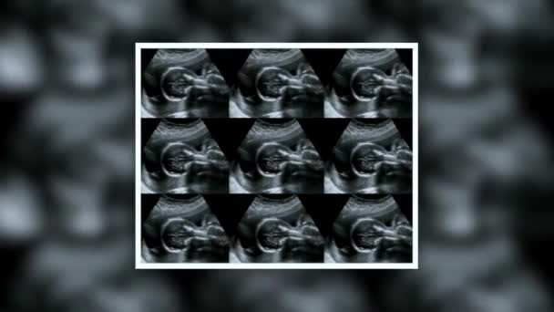 Ecografía Del Bebé Útero Imágenes Médicas Collage Ultrasonido Durante Embarazo Videoclip