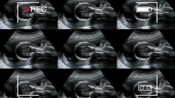 Ultrasuoni Del Bambino Nell Utero Collage Immagini Mediche Ultrasuoni Durante — Video Stock