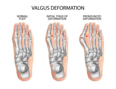 Valgus deformity of the toes. Vector illustration.