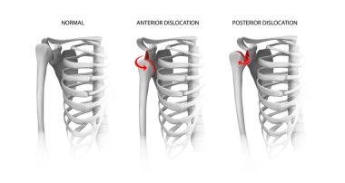 Shoulder dislocation options. Vector illustration.