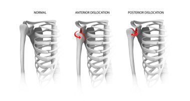 Shoulder dislocation options. Vector illustration. clipart