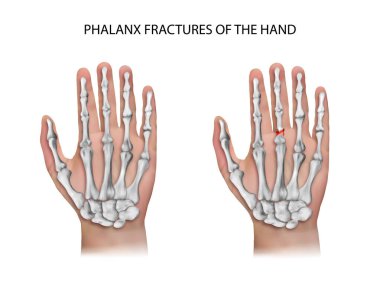 Phalanx Fractures of the Hand. Vector illustration.