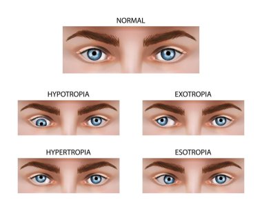 Different types of strabismus. Vector illustration.