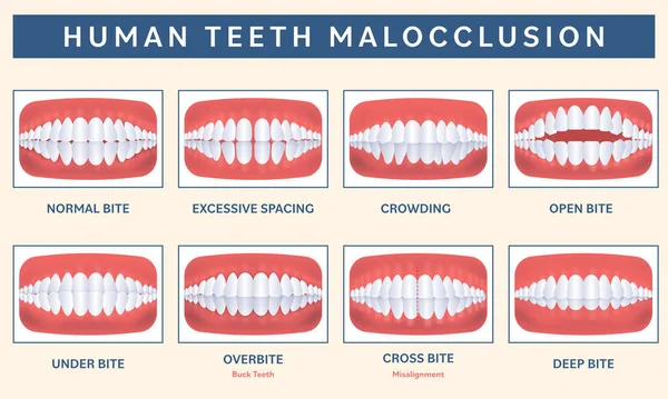 Malocclusion Human Teeth Infographic Icon Set Peach Background — Stock Vector