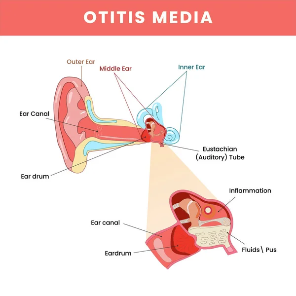 Otitis Media Ear Disease Infographic Structure Colorful Background — Stock Vector