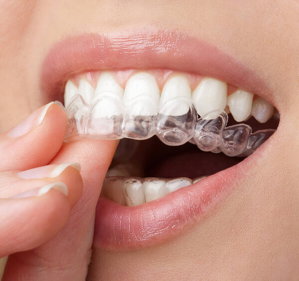 young woman holding whitening tray with gel. home teeth whitening procedure