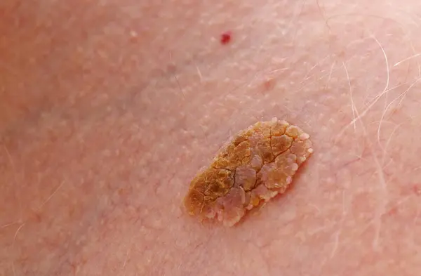 Jóindulatú Melanóma Rosszindulatú Daganat Bőr Stock Kép