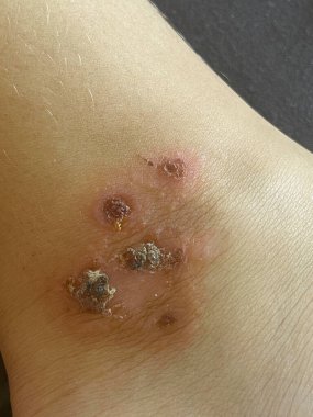 Bacterial infection. Human leg closeup clipart