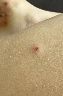 Dermatoloji, tıp ve sağlık hizmetleri konsepti. İnsan derisi yakın plan. Alerji, deri iltihabı, virüs ya da bakteri enfeksiyonu. 